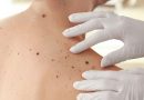 El melanoma representa el 75% de las muertes por cáncer de piel